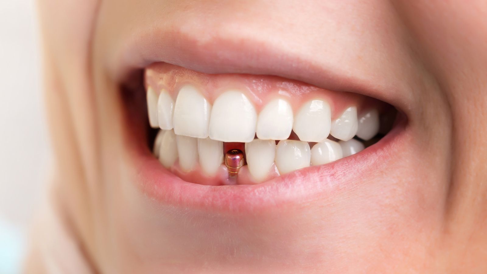  implante dental