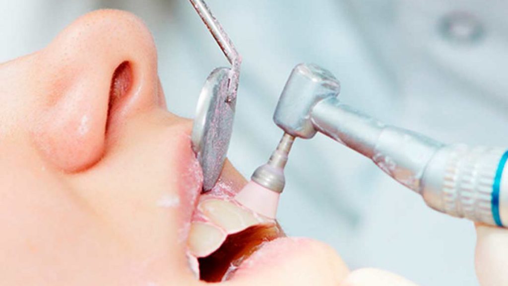 ¿La limpieza dental puede perjudicar el esmalte?