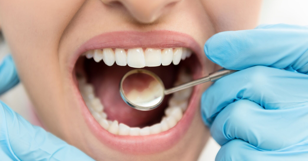 ¿Cómo evitar complicaciones de las caries?