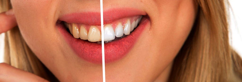 Consejos para cuidar tu blanqueamiento Dental
