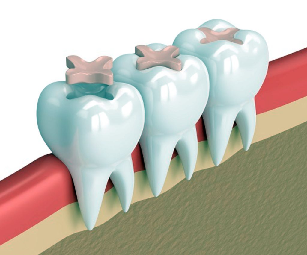 ¿Qué es un sellado dental?